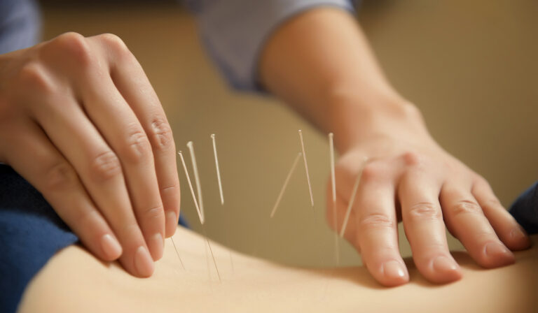 image of dry needling for lower back pain